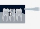 Caries dentales | Recurso educativo 45726