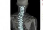 Cifoplastia: Cemento para las vértebras | Recurso educativo 52177