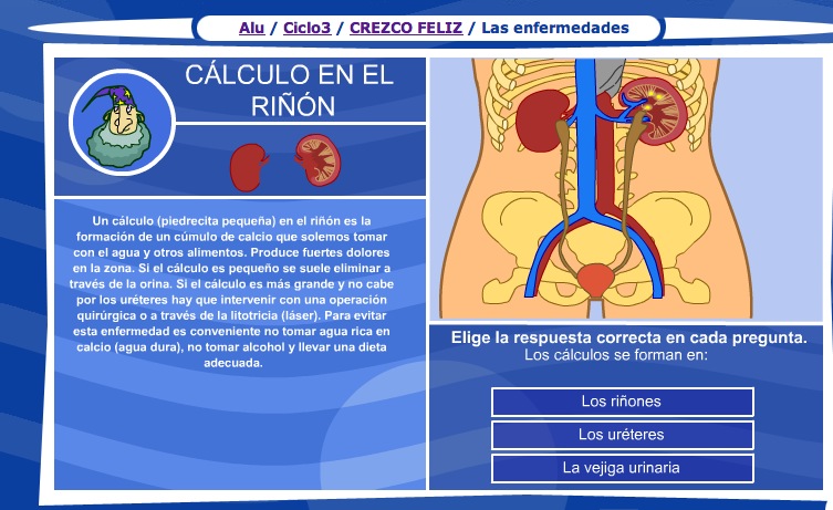 El cálculo en el riñón | Recurso educativo 36056